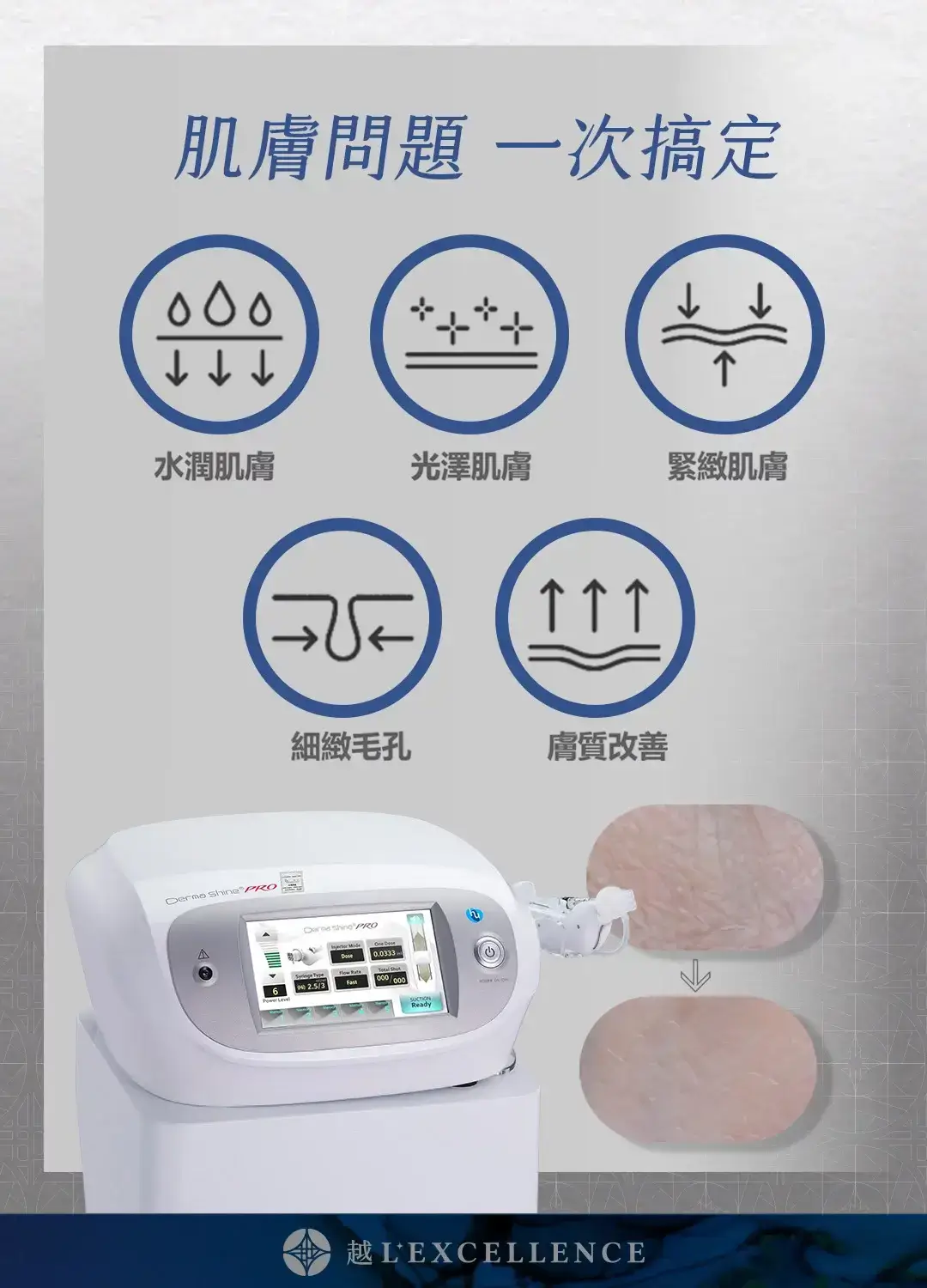 DermaShine 德瑪莎肌膚之光 水光針 水光槍 水光針效果 保濕 緊緻 越診所 Mb02