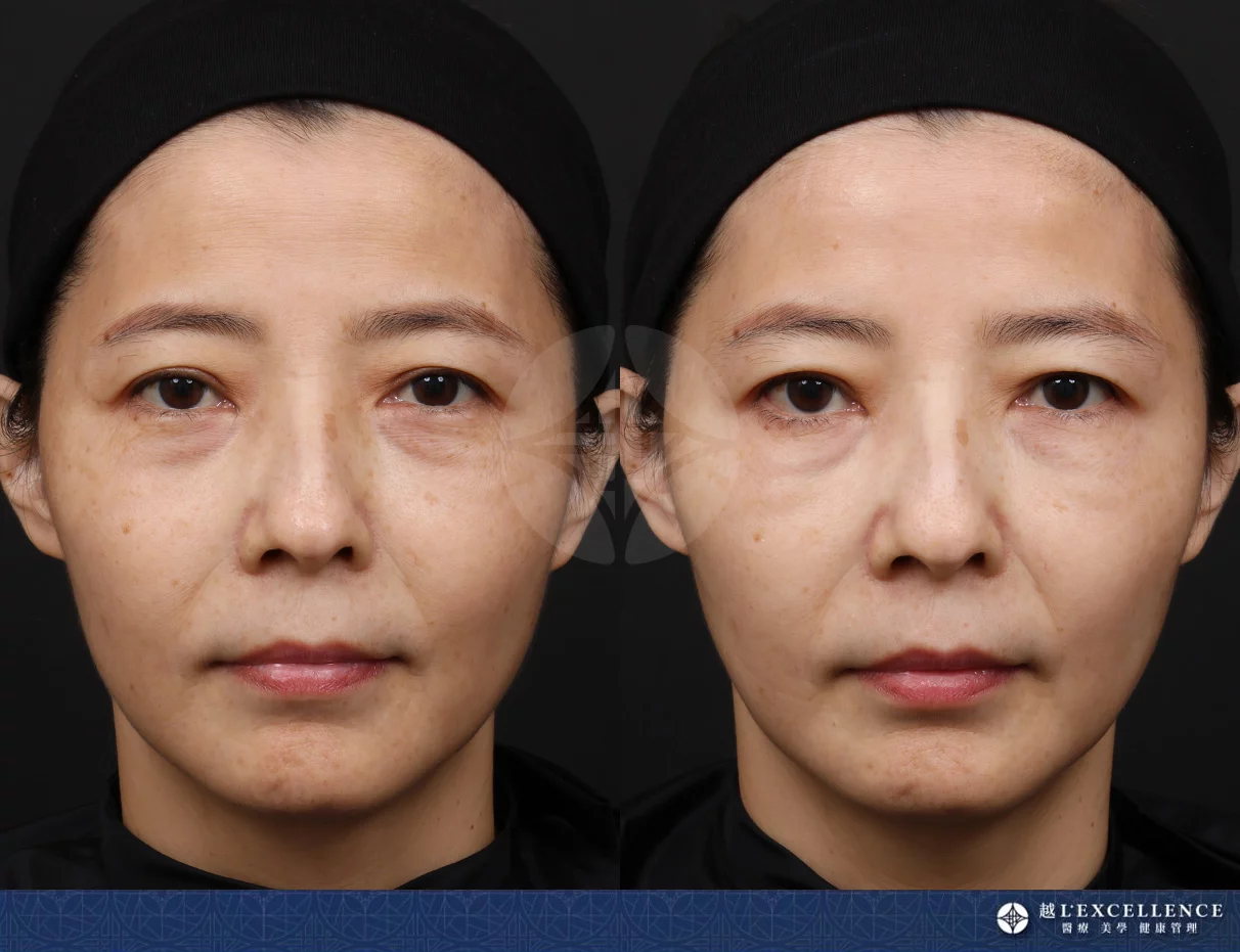 EMFACE菲斯波是什麼?誰適合?價錢?做幾次有感?推薦原因一次看